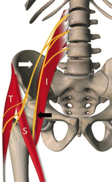 The lateral cutaneous nerve of the thigh is a nerve of the lumbar plexus. Lfcn Nerve : Lateral Femoral Cutaneous Nerve Springerlink ...