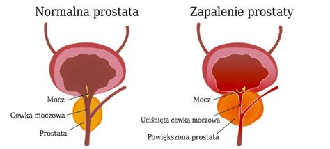 Zapalenie prostaty Objawy i leczenie infekcji gruczołu krokowego