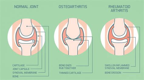 Rheumatoid Arthritis Joint Pain Vs Osteoarthritis Joint Pain Everyday