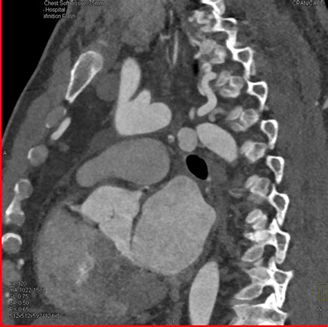 Coarctation Of The Aorta With Collaterals Best Seen On The Sagittal