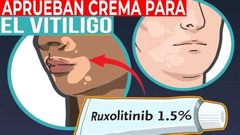 Fda Aprueban Tratamiento En Crema Contra El Vitiligo Vitiligo Cremas