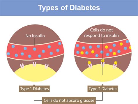 Diabetes A Simple Guide To Understanding Diabetes Pedors Shoes Store