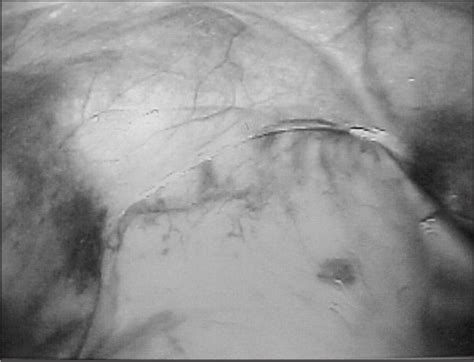 Figure 2 From Laparoscopic Repair Of Blunt Traumatic Anterior Abdominal