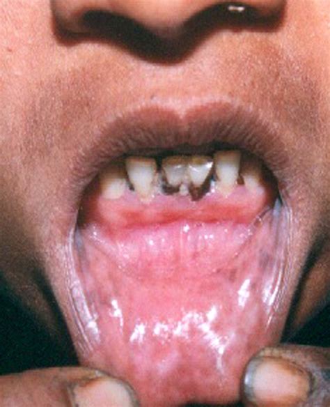Oral Lesions Of Syphilis An Isolated Rare Manifestation