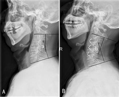 A Preoperative Cervical Lordosis Cobb Angle Of C2c7 A B