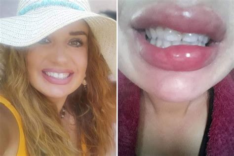 Nhs Worker Branded A ‘monster After Botched Filler Made Her Lips Triple In Size Leaving Them