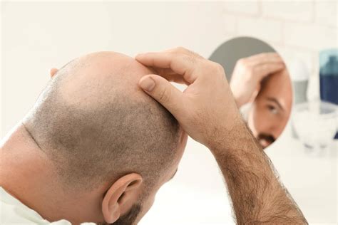 The Complete Guide To Hair Loss Treatment Treatment Rooms