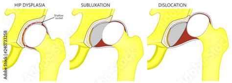 Vector Illustration Anatomy Of A Hip Joint With Dysplasia Subluxation