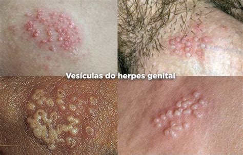 Herpes Genital Cont Gio Sintomas E Tratamento Md Sa De