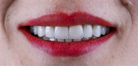 Pros And Cons Of Getting Porcelain Veneers On Your Teeth