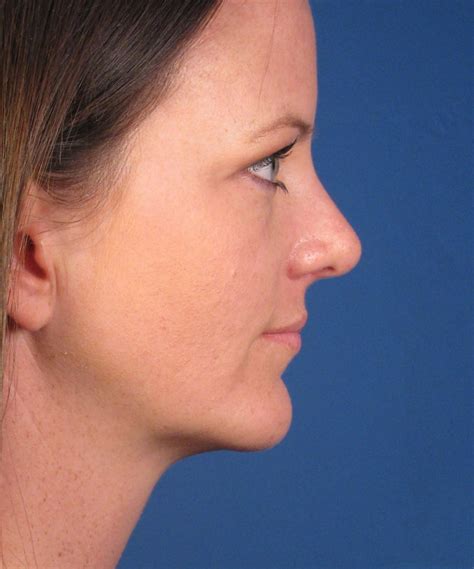 Chin Implant Augmentation Of Jaw Facial Enhancement San Diego Ca