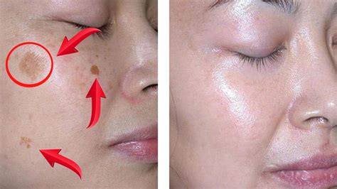 How To Remove Brown Spots On Face Naturally In Just 2 Nights Youtube