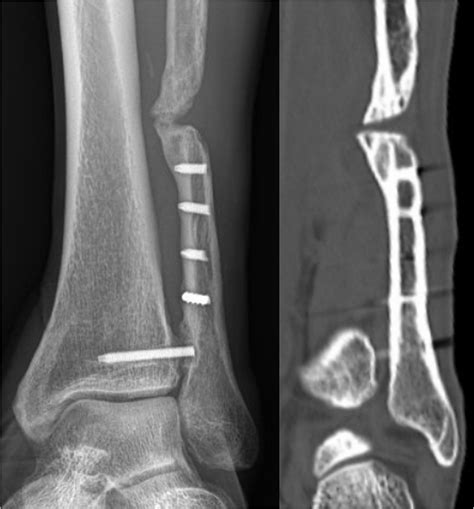 A Nonunion Is Shown After Open Reduction And Internal Fixation Of A