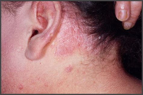 Psoriasis In Ears Pictures Psoriasis Expert