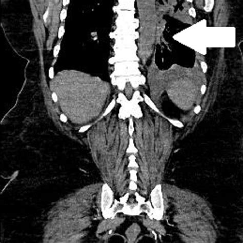 Ct Chest And Thorax Showing Multiple Enlarged Mediastinal Lymph Nodes