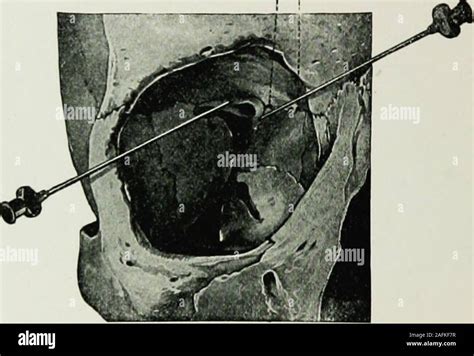Foramen Rotundum Fotos Und Bildmaterial In Hoher Auflösung Alamy