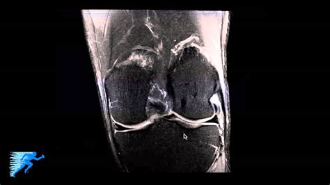 How To Read Knee Mri Of Normal Knee Anatomy Of The Knee Colorado
