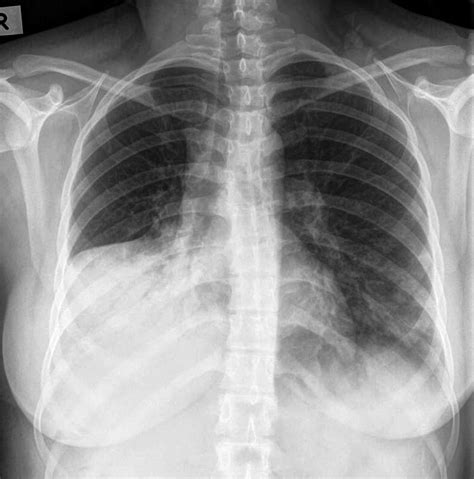 Pulmonary Consolidation Chest X Ray Medschool