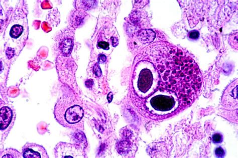 Cytomegalovirus Cmv Infection Nuclear Inclusions Medical Laboratories