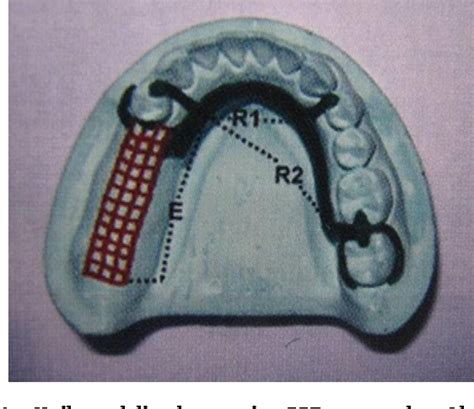 Figure 1 From Comparative Clinical Evaluation Of Removable Partial
