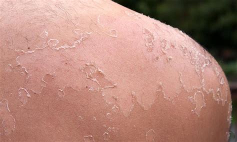 How To Stop Peeling From Sunburn Quick And Easy Way