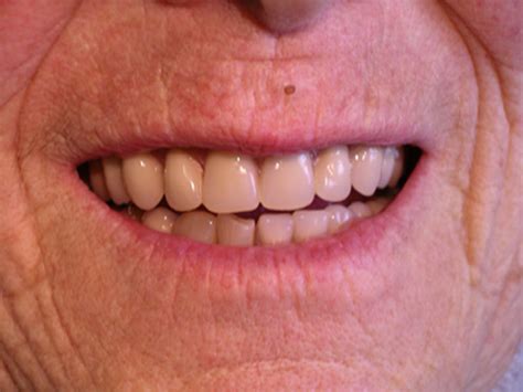 Dentures Full And Partial Cosmetic Dentures Sevenoaks Kent