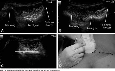 Pdf The Efficacy Of Ultrasonography Guided S 1 Selective Nerve Root
