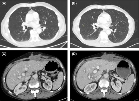 Computer Tomography Scans Of The Thorax And Abdomen Before Ignition Of