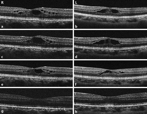 Ah Optical Coherence Tomography OCT Scans Of The Macula Densa Of