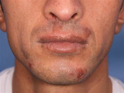 Skin Lesions Erythematous Plaque On Chin And Upper Lip Download