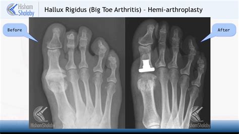 Big Toe Joint Replacement Mr Hisham Shalaby