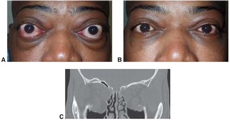 Orbital Decompression For Thyroid Eye Disease American Academy Of Ophthalmology