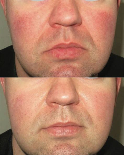 Rosacea Treatment • Aetherclinic