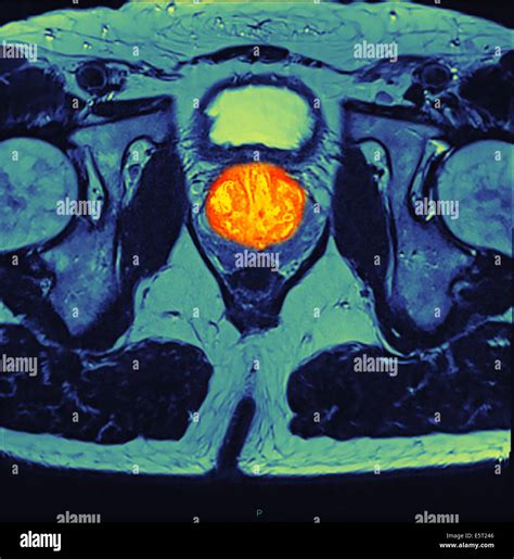 Prostate Cancer Mri Hi Res Stock Photography And Images Alamy