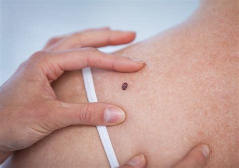 What Is Melanoma And What Are The Early Signs Of The
