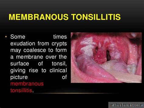Tonsillitis Pptx D Mushtaq Muhadharaty
