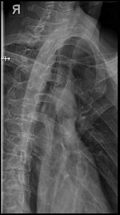 Sternum Oblique View Radiology Reference Article Radiopaedia Org