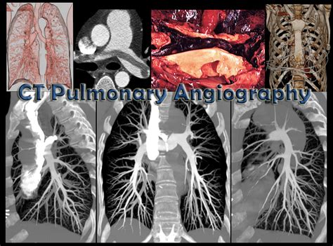 Ct Pulmonary Angiography