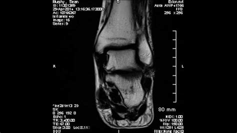 Gray's anatomy for students, 2nd ed. Mr. Sean's Right Foot MRI - YouTube