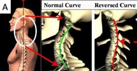 Loss Of Normal Cervical Lordosis Tiktoktoktok