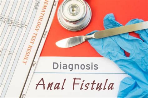 Anal Fistula Surgery In Singapore Expert Fistulectomy Lift Procedure