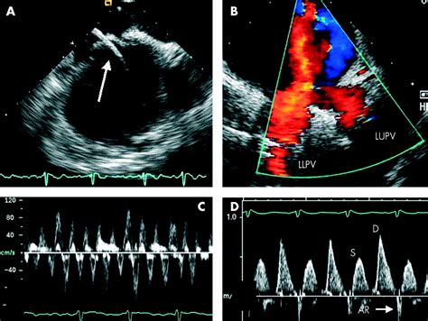 The Role Of Echocardiography In Atrial Fibrillation And Cardioversion