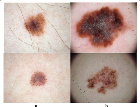 A Few Examples Of Pigmented Skin Lesions A Benign Lesion B Malignant
