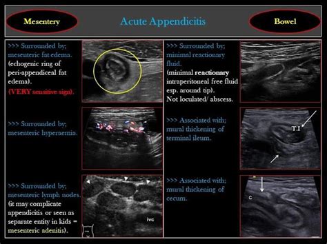 Medical Ultrasound Acute Appendicitis