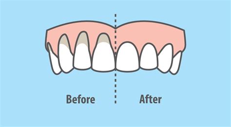What Causes Gum Recession Spectrum Dental Group