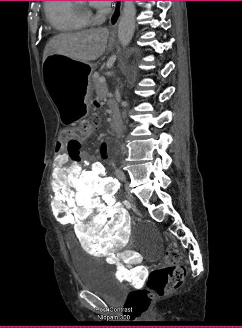 Severely Calcified Peritoneal Metastases Masquerading As Retained