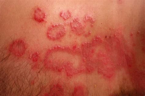 What Is Psoriasis Definition 5 Types Symptoms And Causes 2021