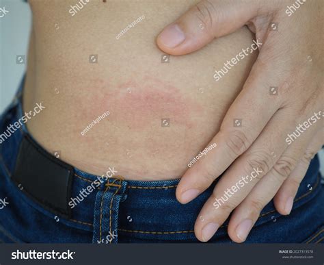 Woman Itchy Urticaria Allergic Skin Reactions Stock Photo 2027313578