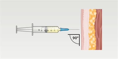 Three Intramuscular Injection Sites