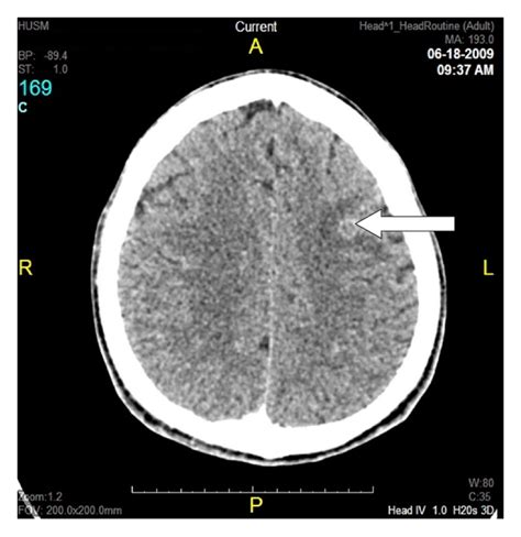Ct Scan Of Brain And Orbit Showed Ill Defined Peripherally Enhancing